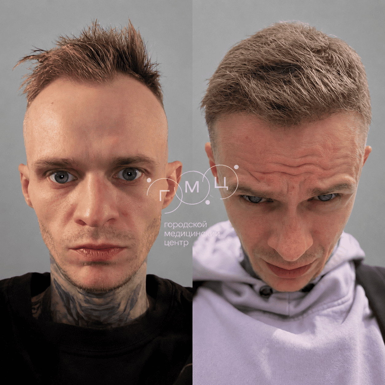 до и после пересадки