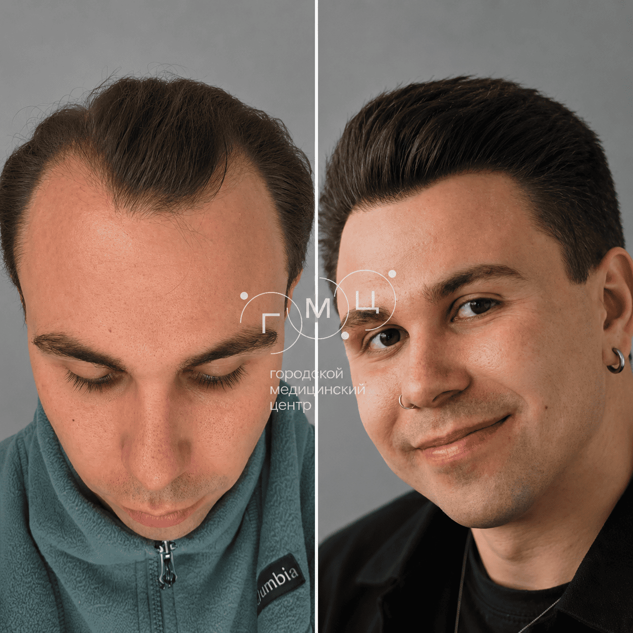 до и после пересадки