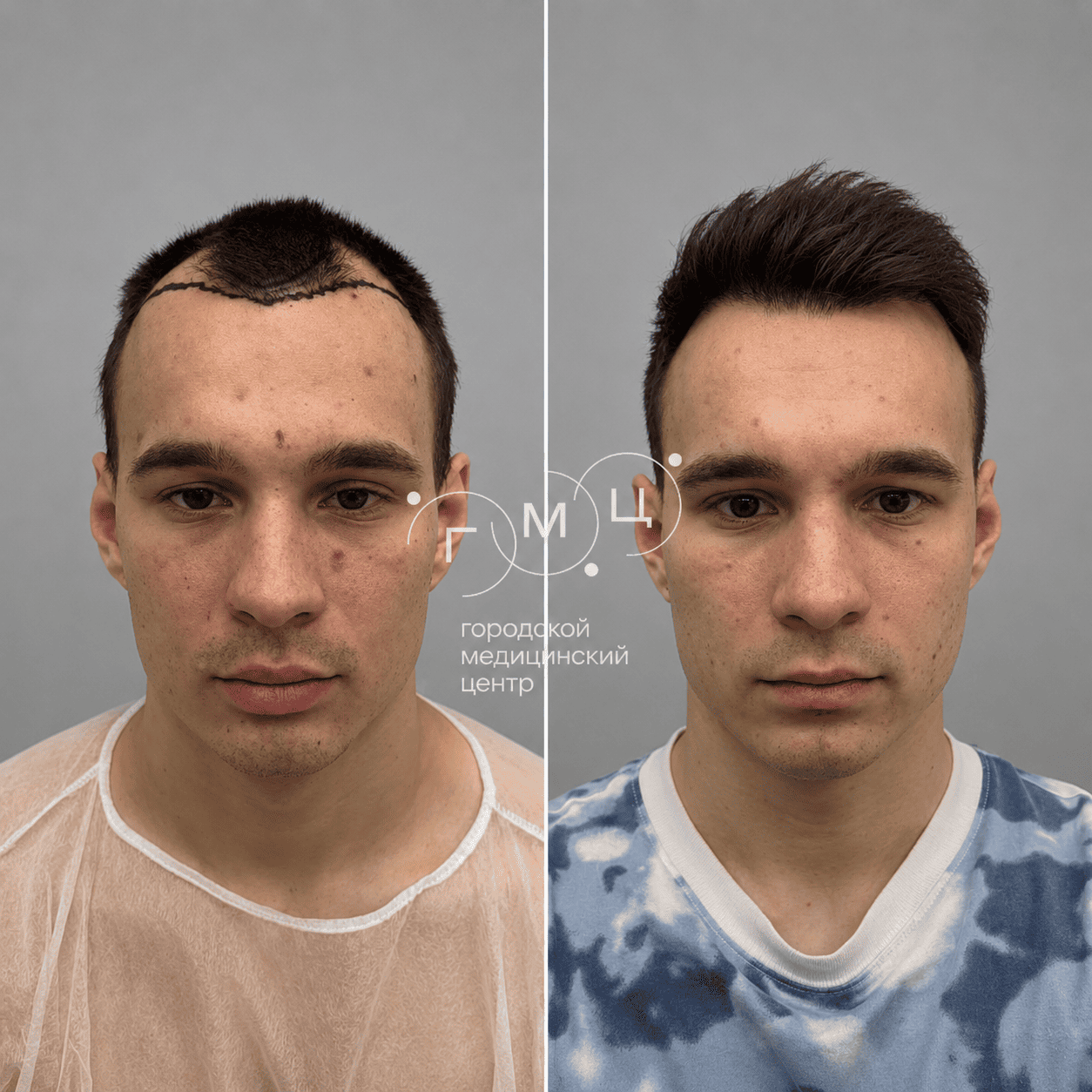 до и после пересадки
